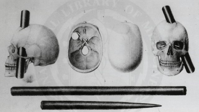 Lobotomías cerebrales